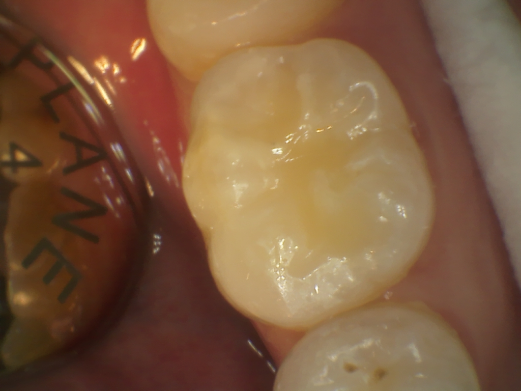 After Restorasi Gigi