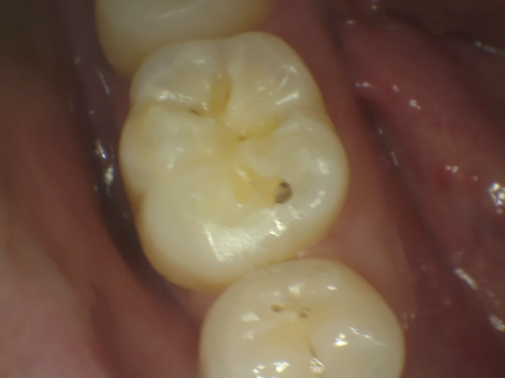 Before Restorasi Gigi